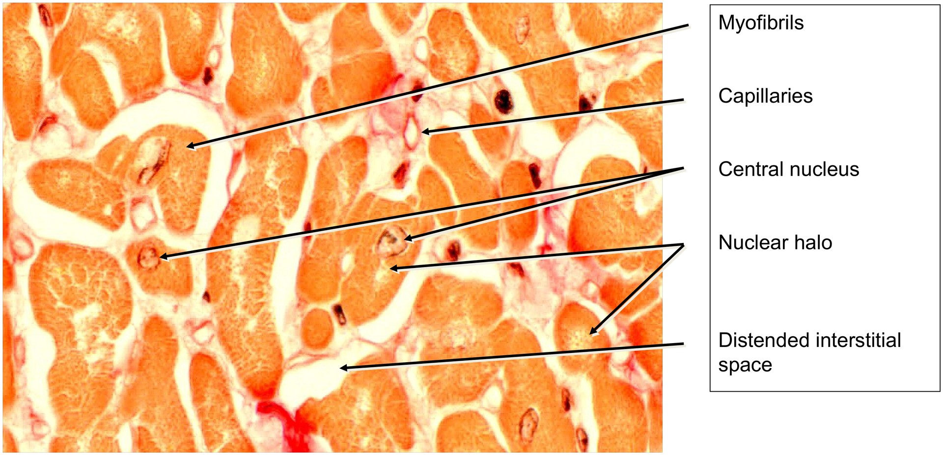 Papillary muscle