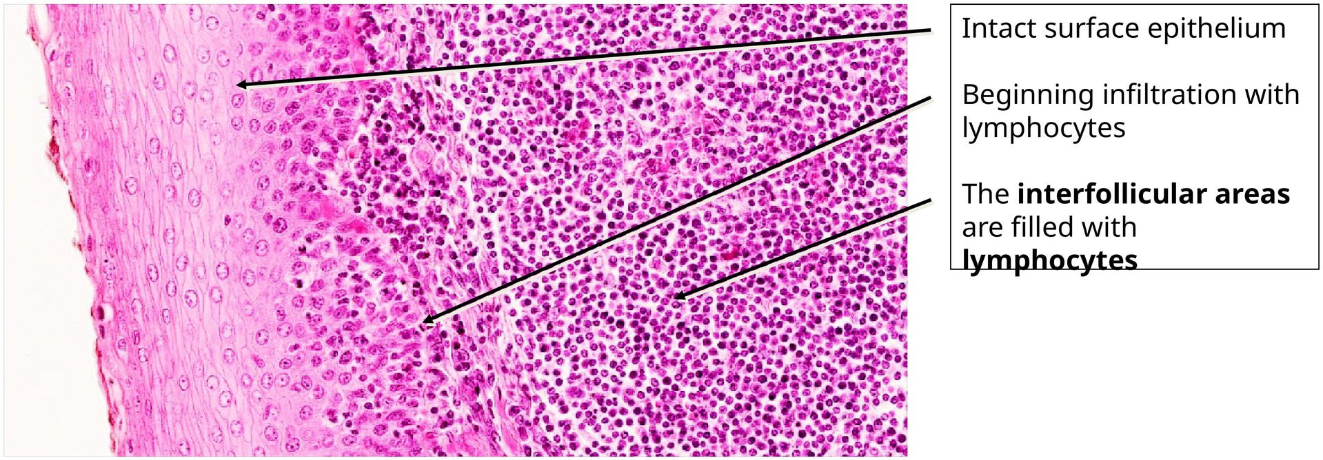 Palatine tonsil