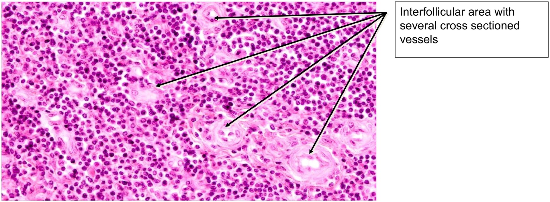 Palatine tonsil