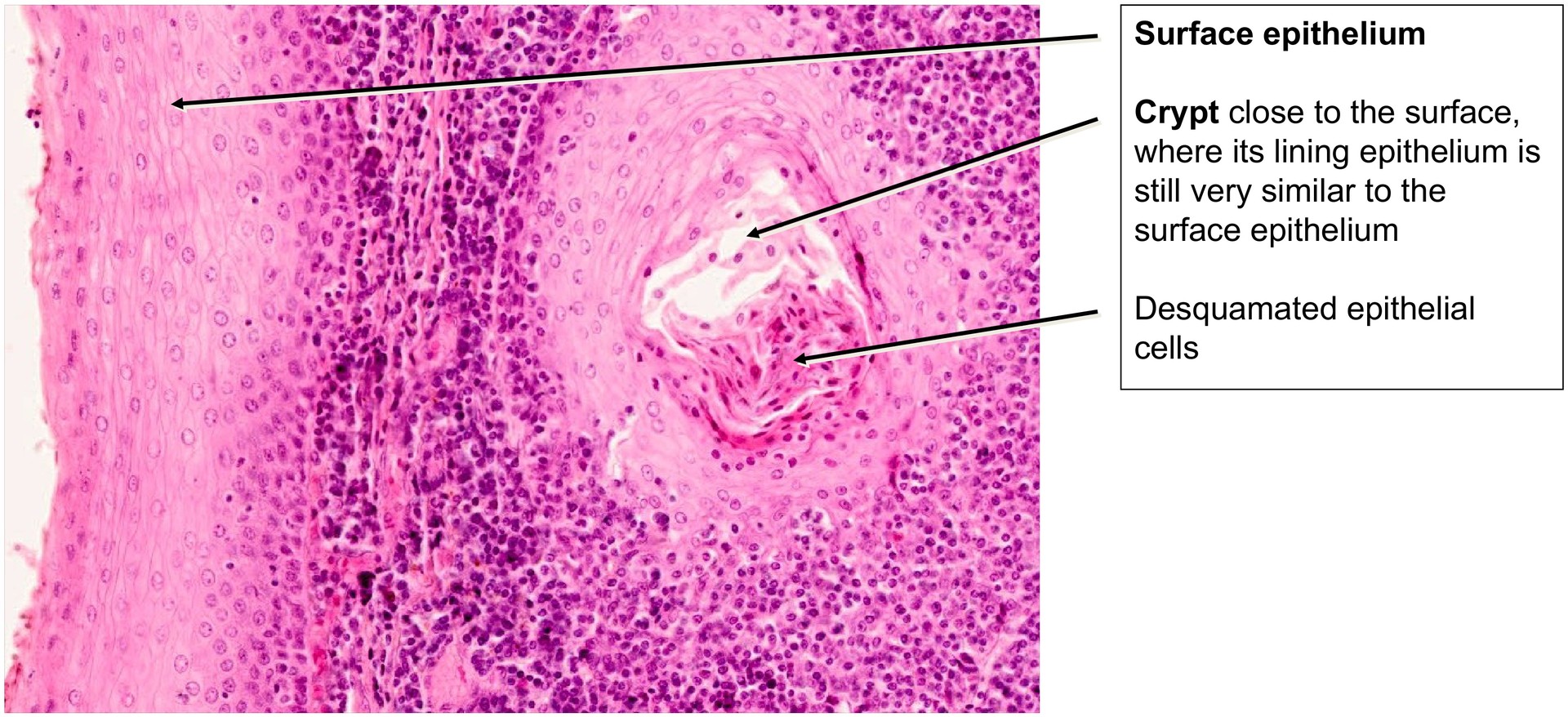 Palatine tonsil